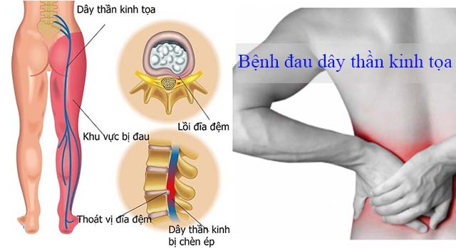 đau dây thần kinh tọa đau dây thần kinh tọa