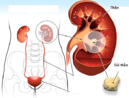 bệnh sỏi thận bệnh sỏi thận