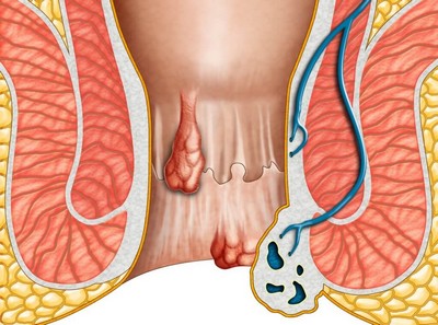 bệnh trĩ bệnh trĩ