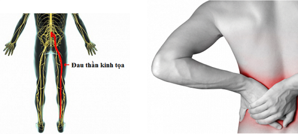 đau thần kinh tọa đau thần kinh tọa