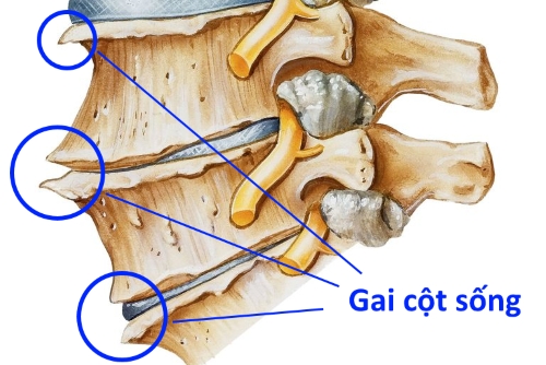 bệnh cột sống tre bệnh cột sống tre