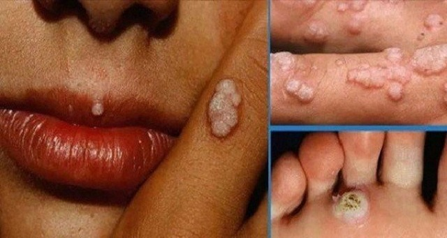 virus hpv gây bệnh virus hpv gây bệnh