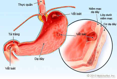 đau dạ dày đau dạ dày