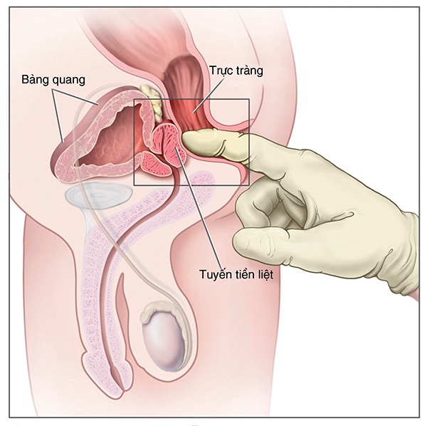u xơ tuyến tiền liệt u xơ tuyến tiền liệt