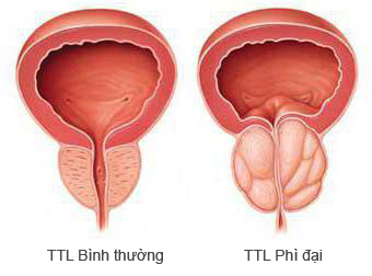 phì đại tuyến tiền liệt phì đại tuyến tiền liệt