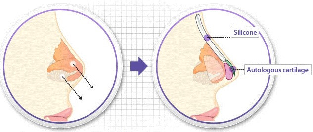 phẫu thuật nâng mũi phẫu thuật nâng mũi