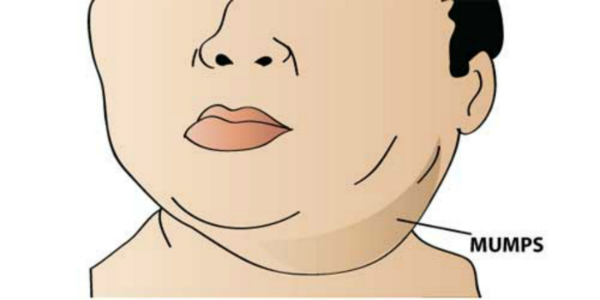 bệnh quai bị bệnh quai bị