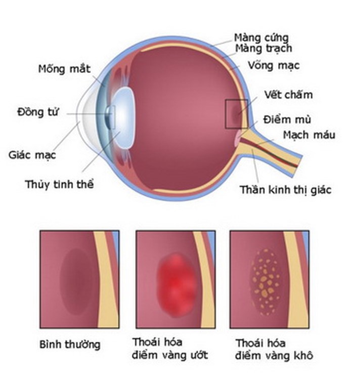 thoái hóa điểm vàng thoái hóa điểm vàng