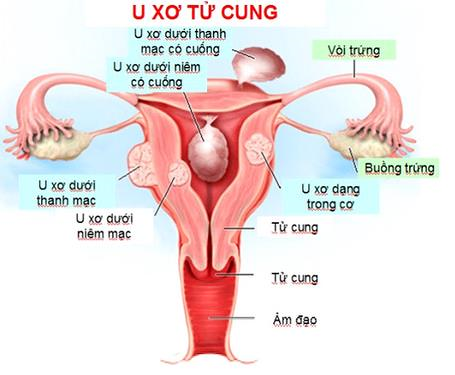 u xơ tử cung u xơ tử cung