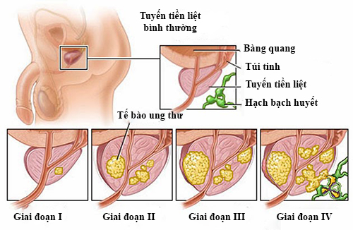 ung thư tuyến tiền liệt ung thư tuyến tiền liệt